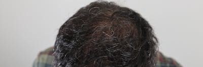 PRP for Hair Before & After Gallery - Patient 87551829 - Image 1