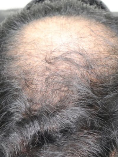 Hair Restoration Before & After Gallery - Patient 87551832 - Image 1