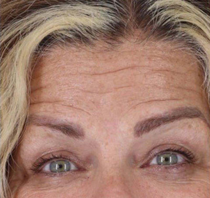 BOTOX Before & After Gallery - Patient 87551825 - Image 1