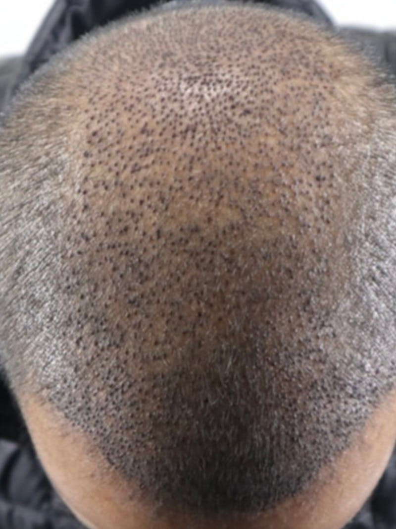 Hair Restoration Before & After Gallery - Patient 87551832 - Image 2