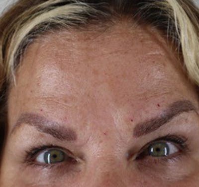 BOTOX Before & After Gallery - Patient 87551825 - Image 2