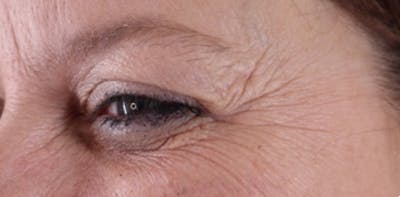 BOTOX Before & After Gallery - Patient 87551842 - Image 1