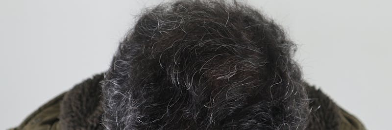 PRP for Hair Before & After Gallery - Patient 87551829 - Image 2