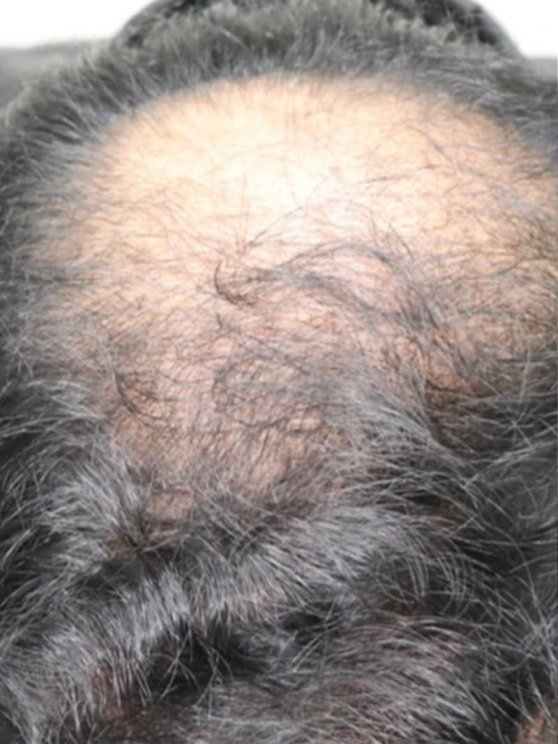 Hair Restoration Before & After Gallery - Patient 87551832 - Image 3