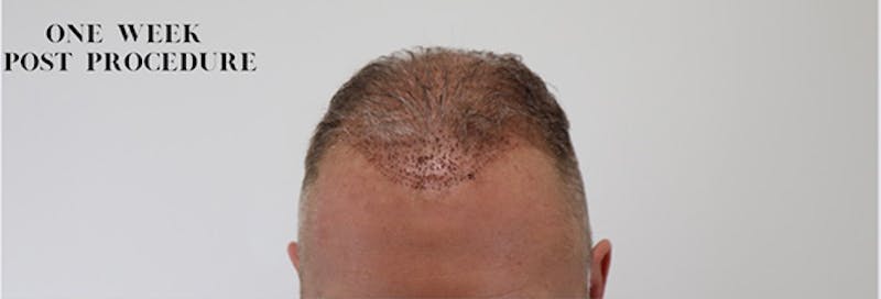 Neograft Before & After Gallery - Patient 87551841 - Image 1