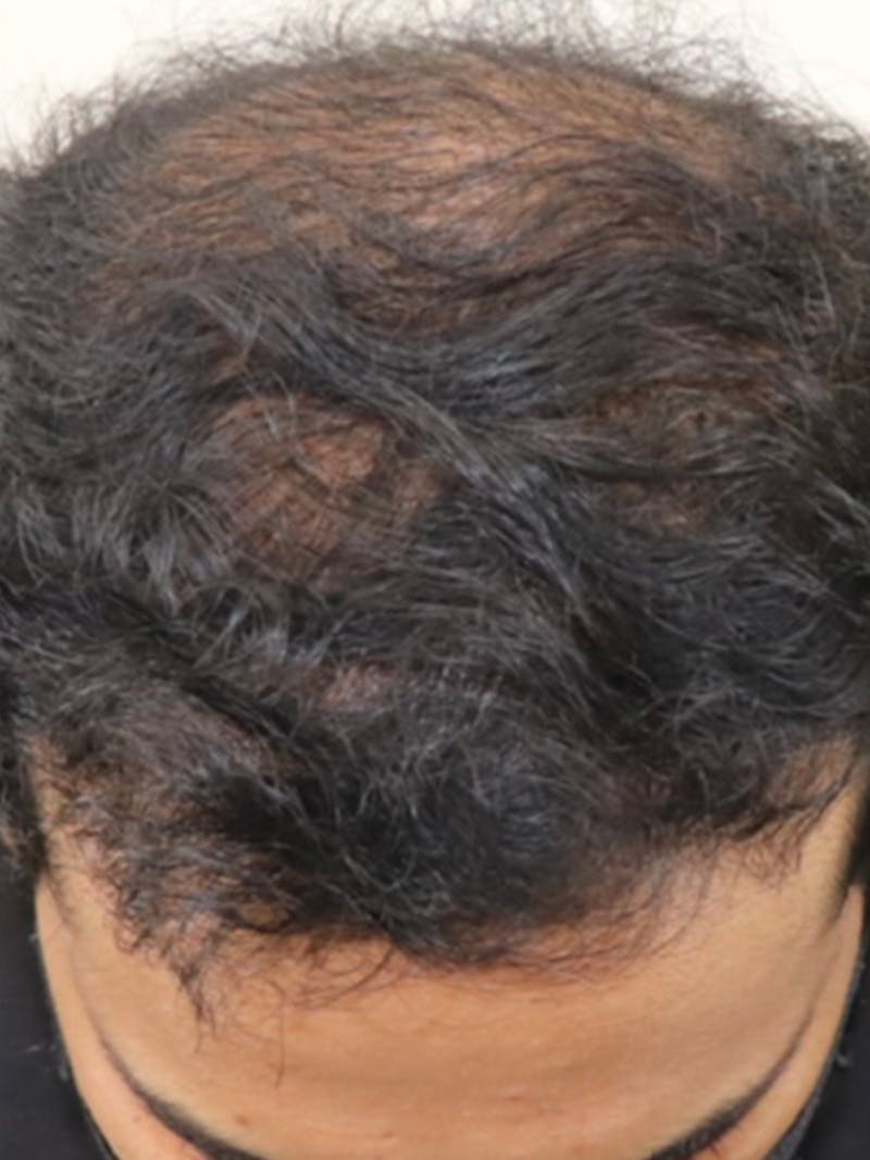 Hair Restoration Before & After Gallery - Patient 87551832 - Image 4