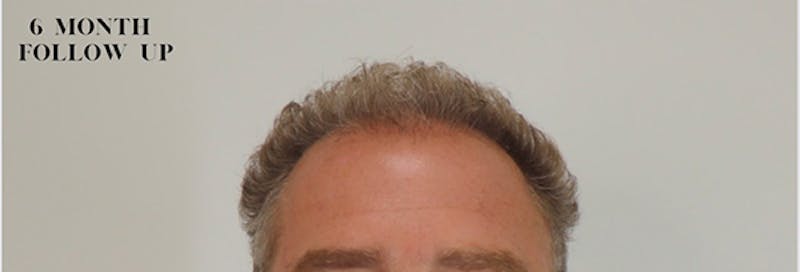 Neograft Before & After Gallery - Patient 87551841 - Image 2