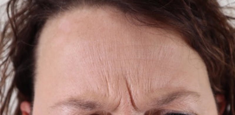 BOTOX Before & After Gallery - Patient 87551842 - Image 3