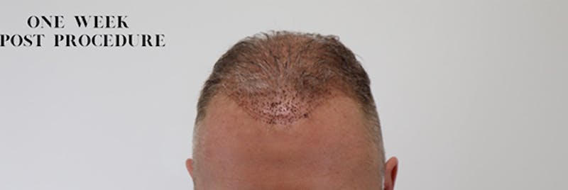 Hair Restoration Before & After Gallery - Patient 87551835 - Image 1