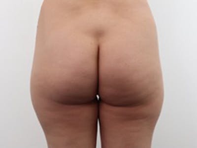 Brazilian Butt Lift Before & After Gallery - Patient 87551838 - Image 1