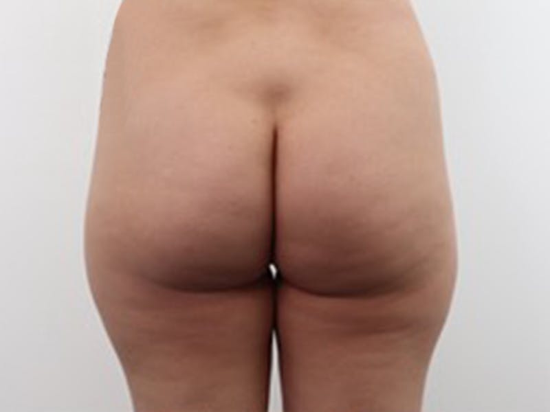 Brazilian Butt Lift Before & After Gallery - Patient 87551838 - Image 1