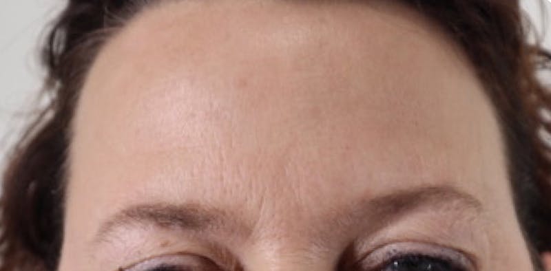 BOTOX Before & After Gallery - Patient 87551842 - Image 4
