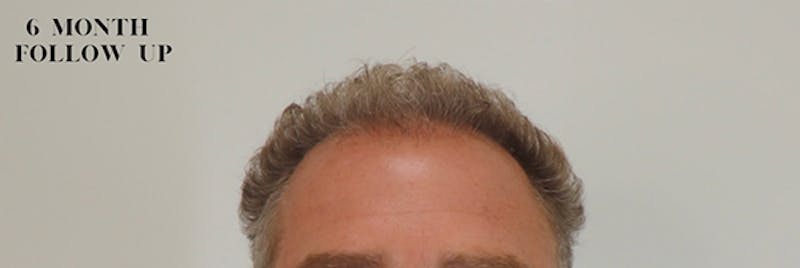 Hair Restoration Before & After Gallery - Patient 87551835 - Image 2