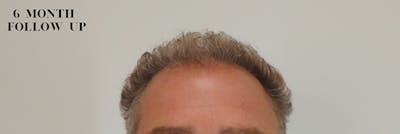 Hair Restoration Before & After Gallery - Patient 87551835 - Image 2