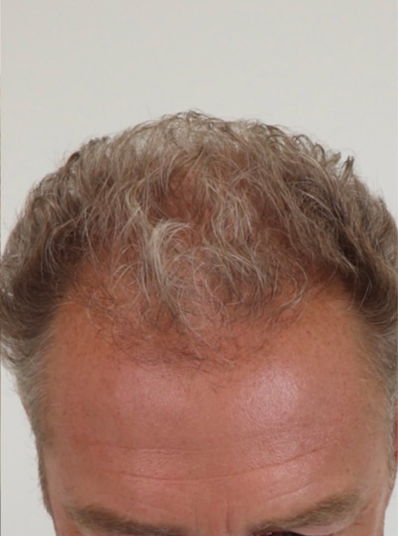 Neograft Before & After Gallery - Patient 87551841 - Image 4