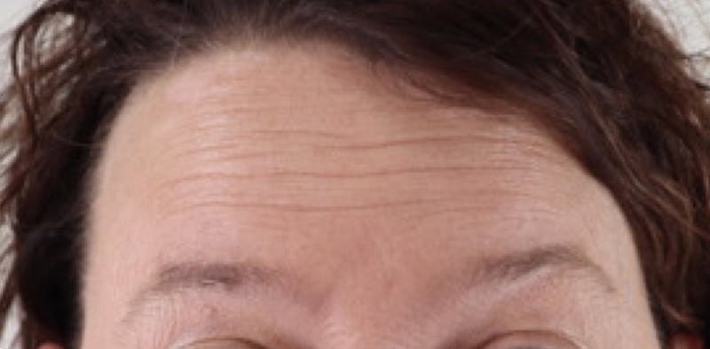BOTOX Before & After Gallery - Patient 87551842 - Image 5