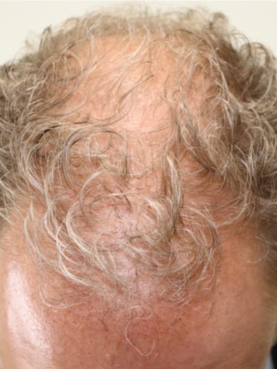 Hair Restoration Before & After Gallery - Patient 87551839 - Image 1