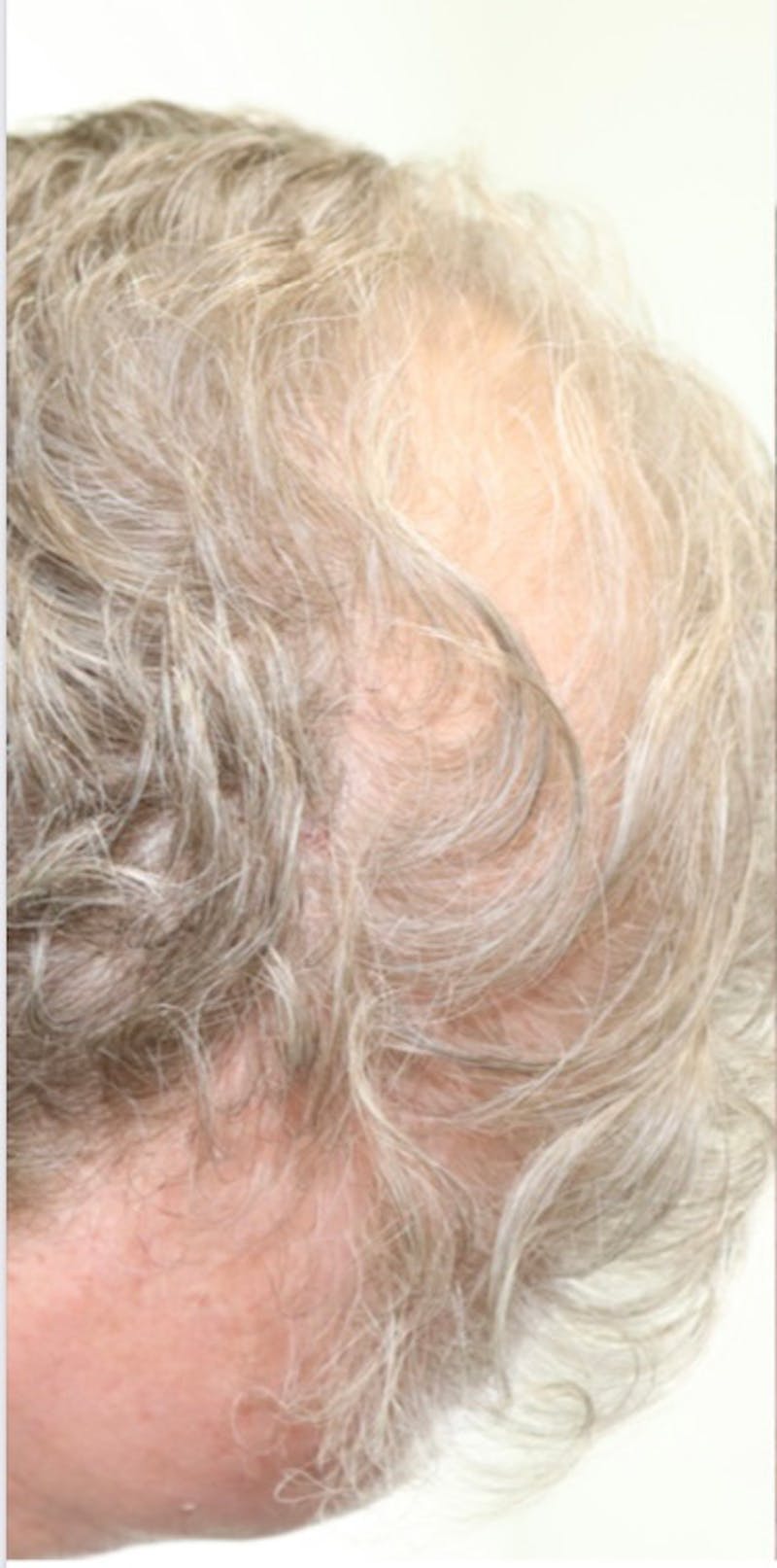 Neograft Before & After Gallery - Patient 87551841 - Image 5