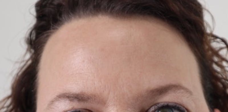 BOTOX Before & After Gallery - Patient 87551842 - Image 6