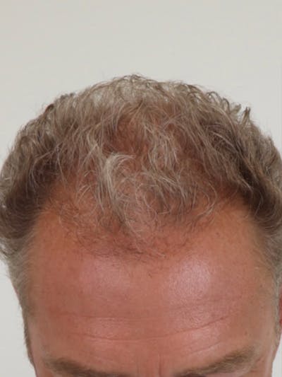 Hair Restoration Before & After Gallery - Patient 87551839 - Image 2