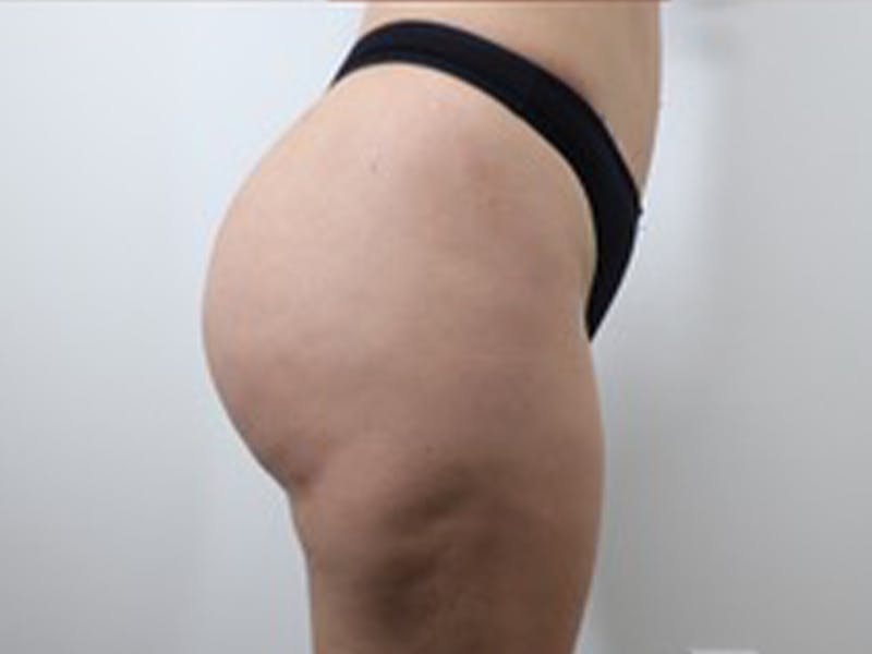 Brazilian Butt Lift Before & After Gallery - Patient 87551838 - Image 4