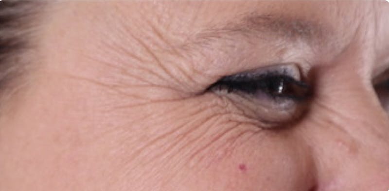 BOTOX Before & After Gallery - Patient 87551842 - Image 7