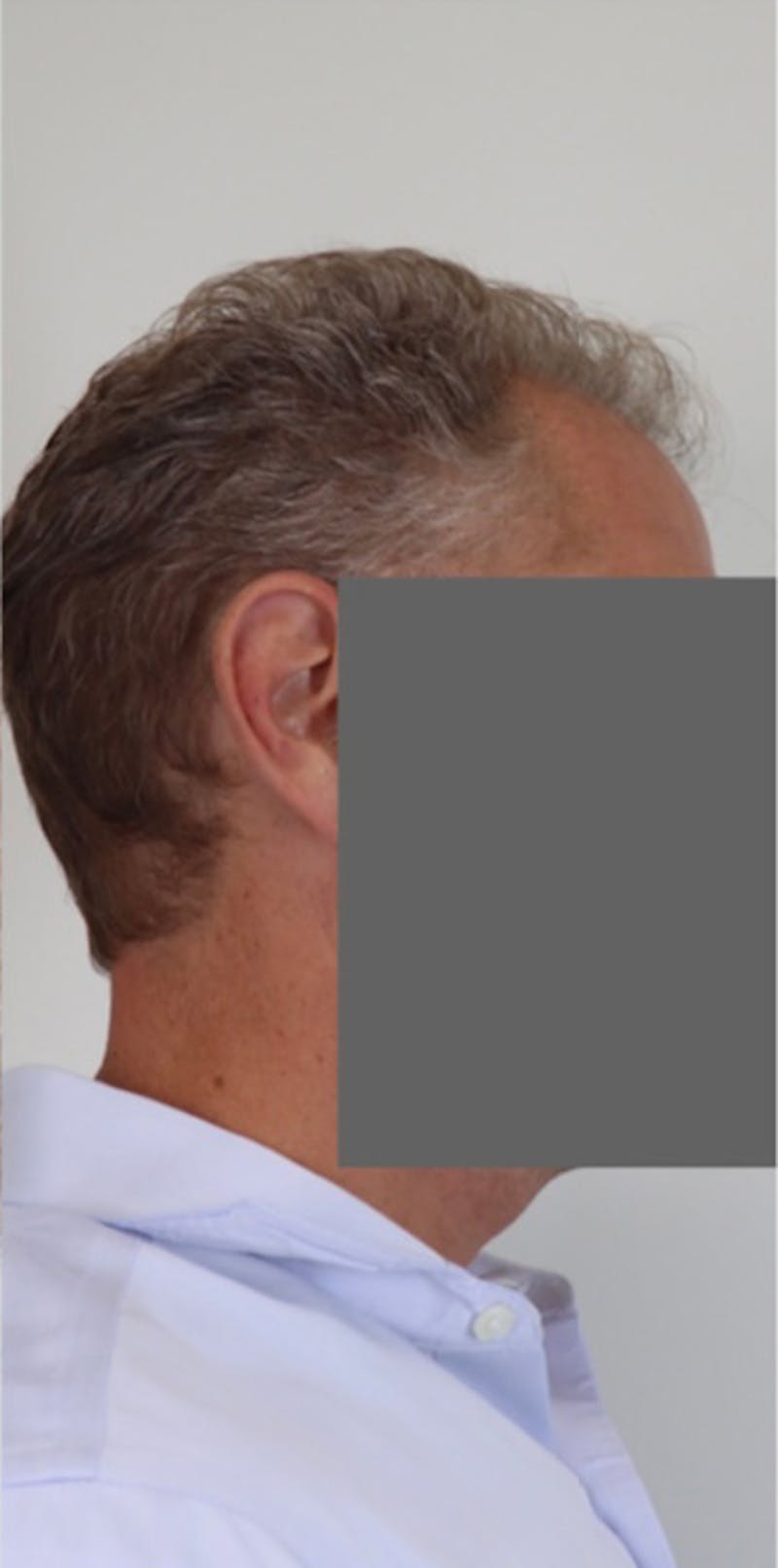 Neograft Before & After Gallery - Patient 87551841 - Image 7