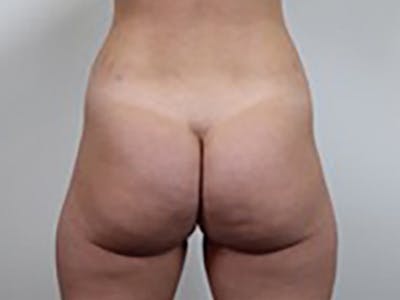 Brazilian Butt Lift Before & After Gallery - Patient 87551846 - Image 1
