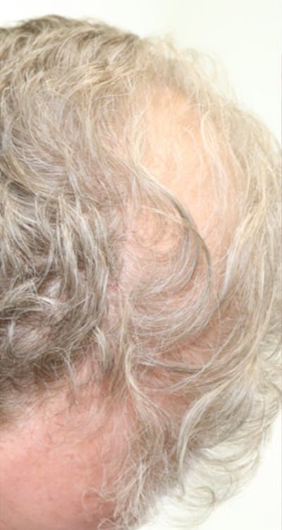 Hair Restoration Before & After Gallery - Patient 87551849 - Image 1