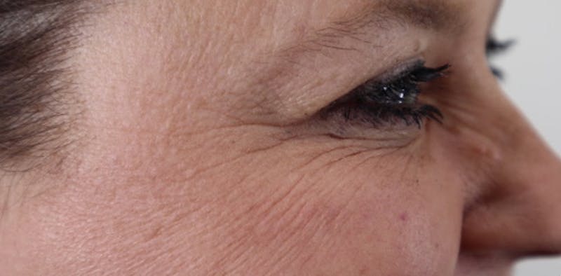 BOTOX Before & After Gallery - Patient 87551842 - Image 8