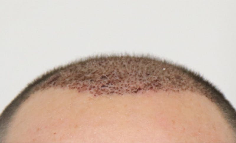 Neograft Before & After Gallery - Patient 87551844 - Image 1