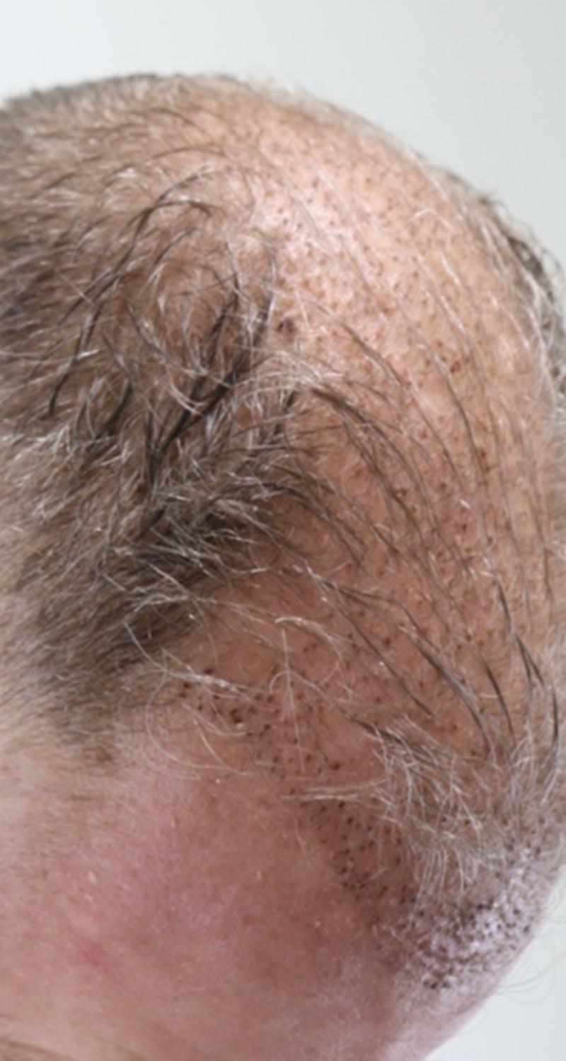 Hair Restoration Before & After Gallery - Patient 87551849 - Image 2