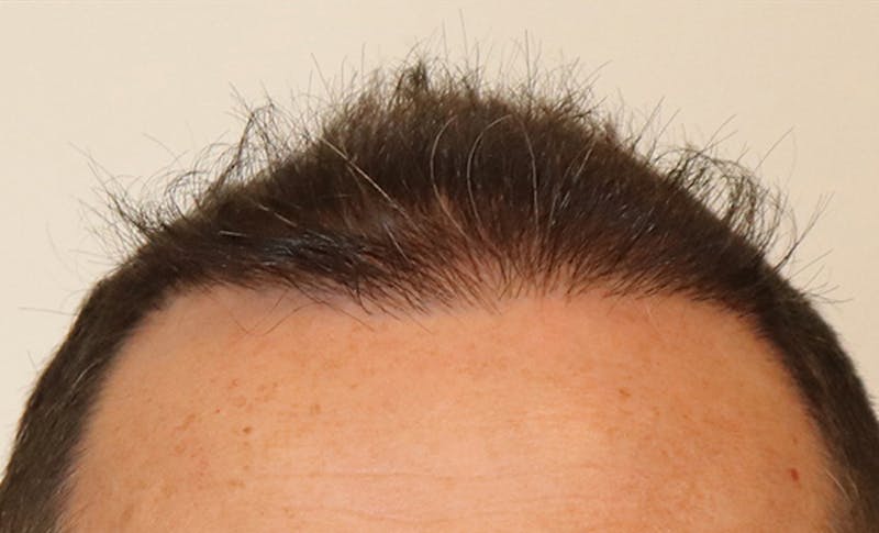 Neograft Before & After Gallery - Patient 87551844 - Image 2
