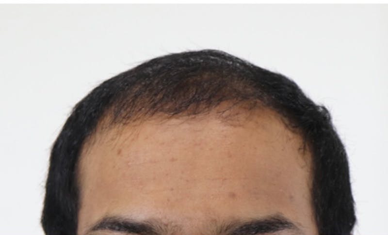 Neograft Before & After Gallery - Patient 87551854 - Image 1