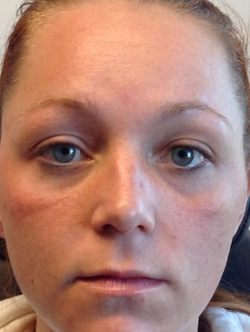 BOTOX Before & After Gallery - Patient 87551856 - Image 3
