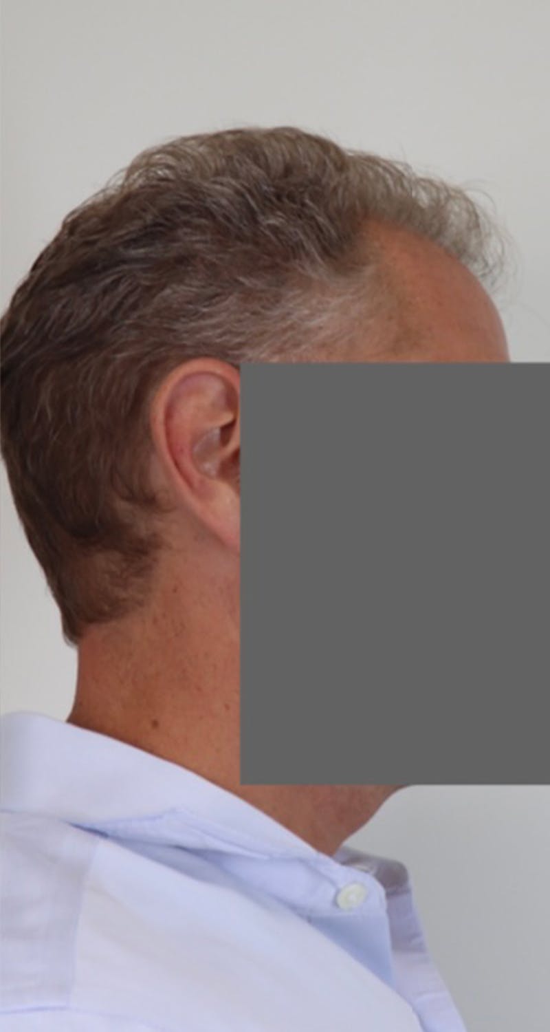 Hair Restoration Before & After Gallery - Patient 87551849 - Image 4