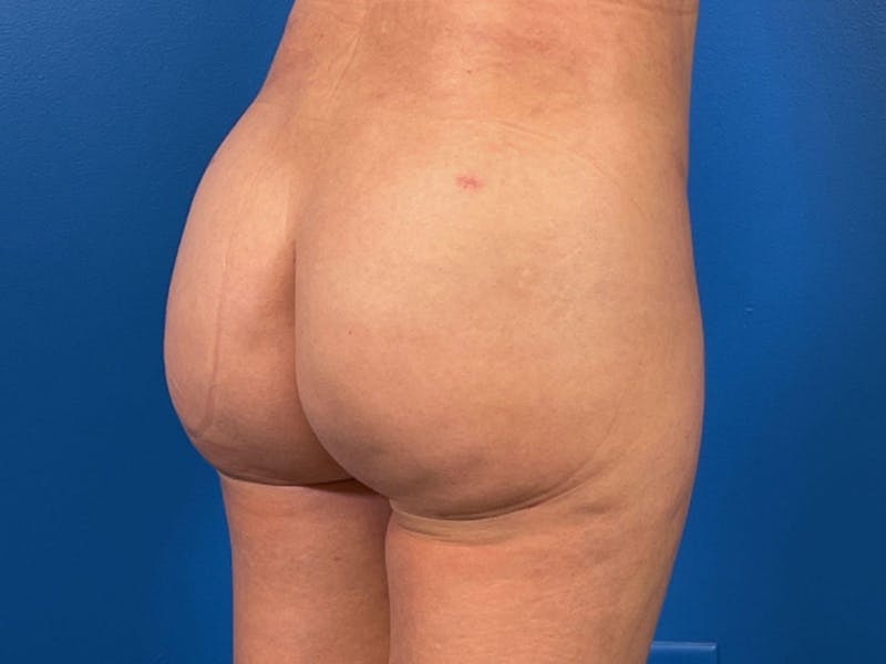 Brazilian Butt Lift Before & After Gallery - Patient 87551850 - Image 2