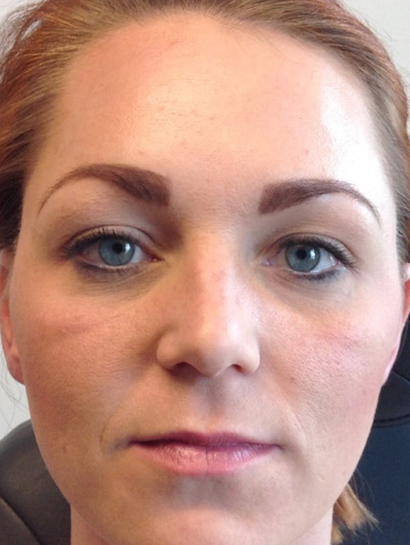 BOTOX Before & After Gallery - Patient 87551856 - Image 4
