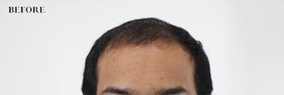 Hair Restoration Before & After Gallery - Patient 87551853 - Image 1