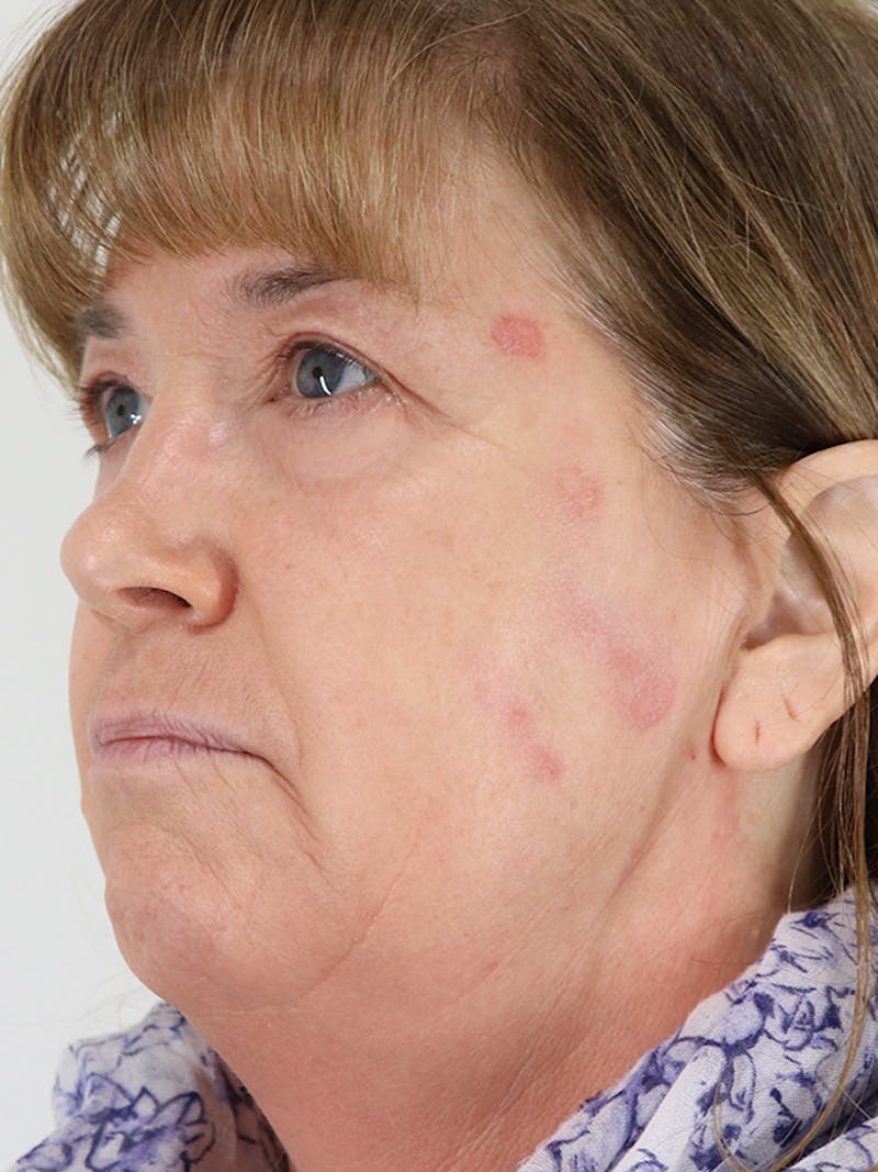 Microneedling Before & After Gallery - Patient 87551857 - Image 1