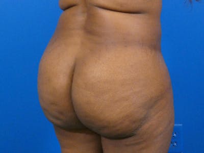 Brazilian Butt Lift Before & After Gallery - Patient 87551858 - Image 1