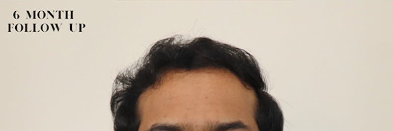 Hair Restoration Before & After Gallery - Patient 87551853 - Image 2