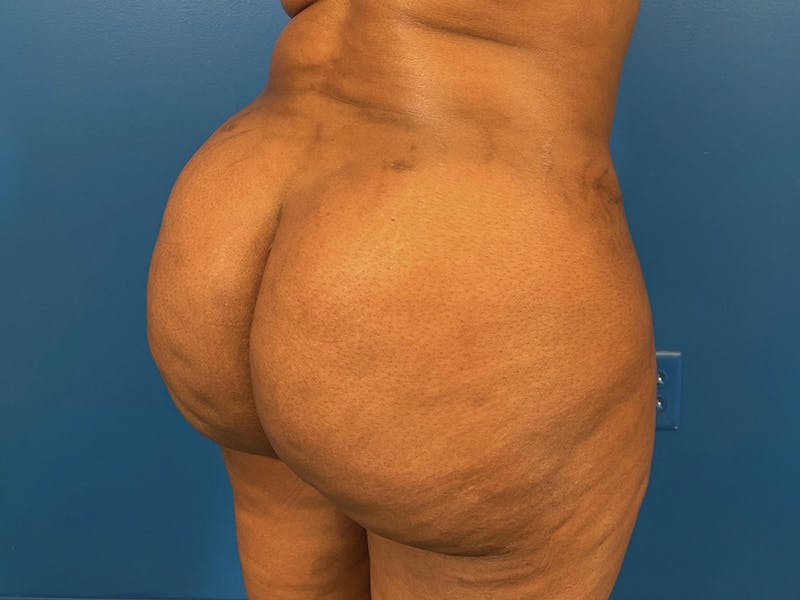 Brazilian Butt Lift Before & After Gallery - Patient 87551858 - Image 2