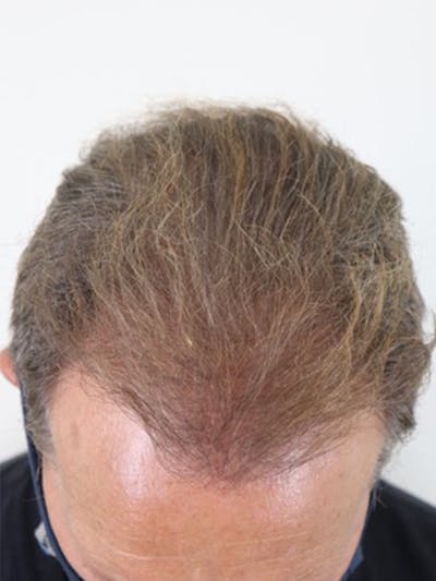 Hair Restoration Before & After Gallery - Patient 87551864 - Image 1