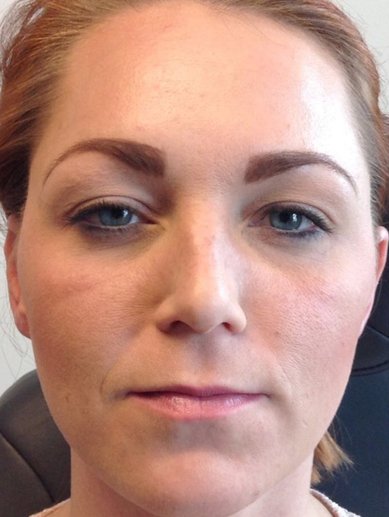 BOTOX Before & After Gallery - Patient 87551856 - Image 6