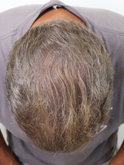 Hair Restoration Before & After Gallery - Patient 87551864 - Image 2