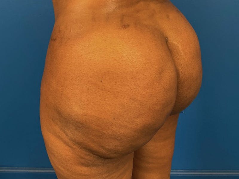 Brazilian Butt Lift Before & After Gallery - Patient 87551858 - Image 4