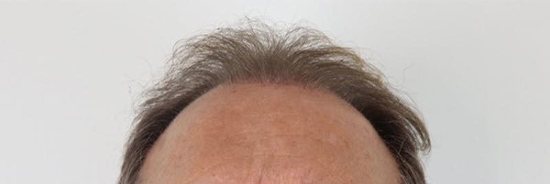 Hair Restoration Before & After Gallery - Patient 87551864 - Image 3