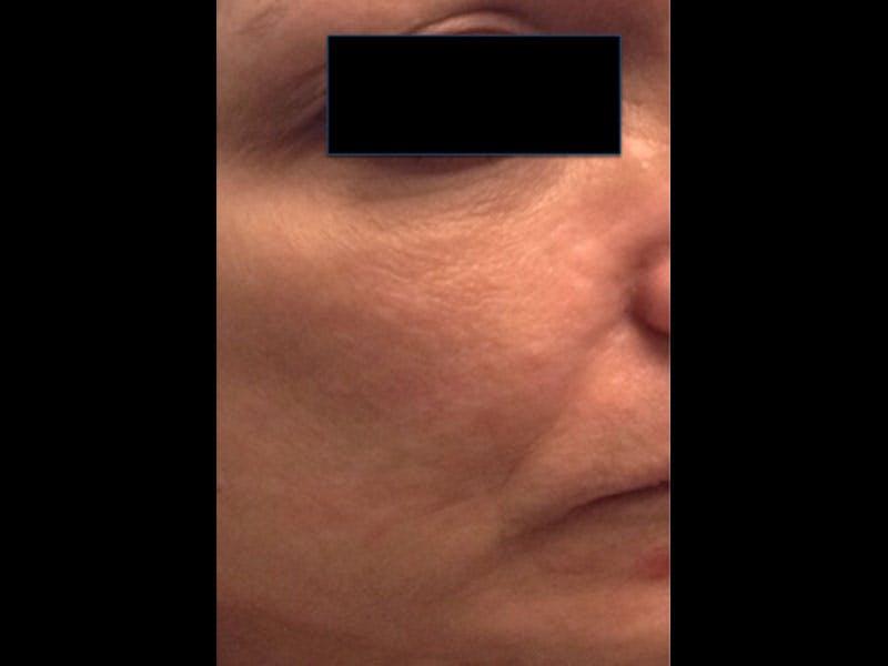 Microneedling Before & After Gallery - Patient 87551861 - Image 1