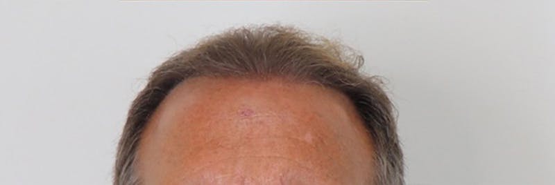 Hair Restoration Before & After Gallery - Patient 87551864 - Image 4